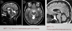 Киста прозрачной перегородки головного мозга (полость Верге): симптомы, лечение и последствия
