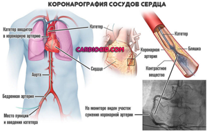 Коронарография сердечных сосудов: как делают, показания, последствия
