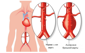 Аневризма аорты: симптомы, что это такое, расширение восходящего отдела, корня