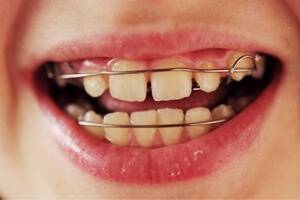 Пластины на зубы: выравнивание зубов у детей и взрослых, фото до и после, сколько носить