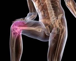 Причины синовиального хондроматоза коленного сустава, классификация, хирургическое лечение