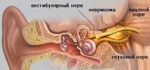 Невринома головного и спинного мозга, слухового нерва: симптомы и лечение