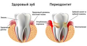 Зубы мудрости: где находятся и как выглядят после удаления, строение, как растут, сколько корней