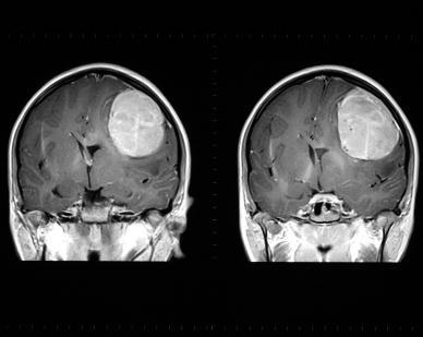 Смерть головного мозга: как развивается, причины, признаки, постановка диагноза