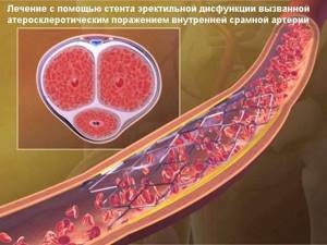 Вены на половых органах у мужчин: норма и патология, варикоз, воспаление
