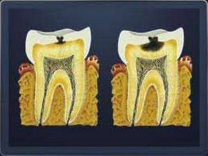 Отек щеки после удаления зуба: почему появляется, сколько держится, как снять в домашних условиях