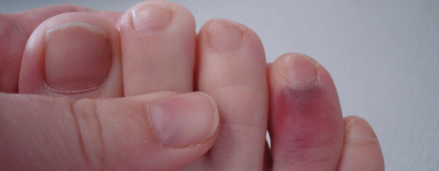 Ушиб пальца на руке: чем лечить, симптомы и последствия