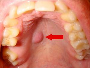 Шишка на губе (фото): лечение и причины появления