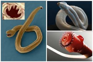 Скребни черви: чем опасны для человека и какие у них симптомы