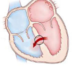 Дефект межжелудочковой перегородки сердца (ДМЖП): причины, проявления, лечение