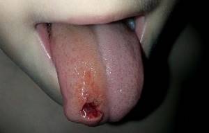 Кровоточит язык: причины, как остановить, почему, что делать
