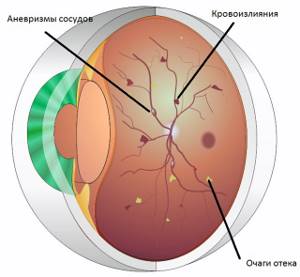 Что делать, если падает зрение при сахарном диабете, лечение глаз