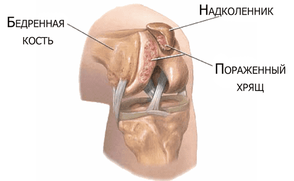 Что такое хондропатия коленного сустава: основные методы диагностики и лечения