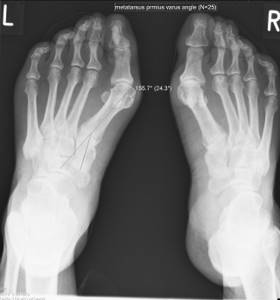 Болит сустав большого пальца на ноге: чем лечить и как, причины появления боли