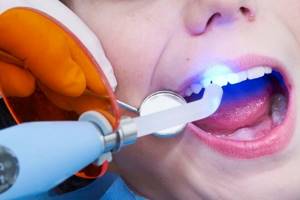 Сколько нельзя есть после пломбирования зуба световой и временной пломбой