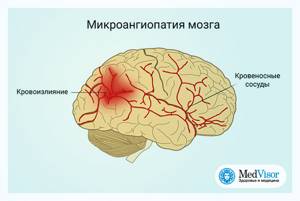 Микроангиопатия головного мозга (церебральная): что это такое симптомы и прогноз жизни