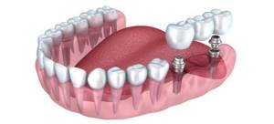 Зубной мост: виды, какой лучше, как делают и ставят, сколько стоит мостовидный протез