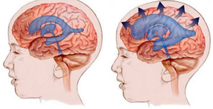 Гидроцефалия (“водянка мозга”): как развивается, формы, проявления, лечение, последствия