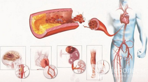 Аневризма грудного отдела аорты, восходящей дуги - как развивается, проявления и диагностика, лечение