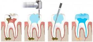 Почему болит зуб после удаления нерва, чистки каналов и пломбирования при надавливании