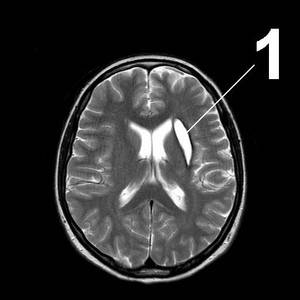 Лечение кисты головного мозга — методики, отзывы врачей и пациентов, последствия