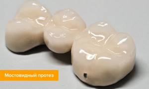 Зубной мост: виды, какой лучше, как делают и ставят, сколько стоит мостовидный протез