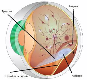 Что делать, если падает зрение при сахарном диабете, лечение глаз