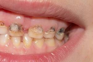 Пульпит молочного зуба у ребенка – симптомы, этапы лечения, профилактика