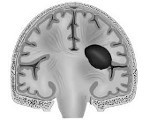 Гематома головного мозга и ее последствия — симптомы и эффективное лечение травмы