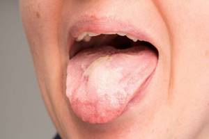 Болезни языка: симптомы и описания заболеваний языка, чем лечить, фото
