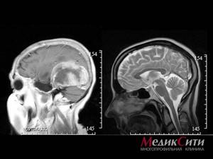 Черепно-мозговая травма (ЧМТ), травмы головы: причины, виды, признаки, помощь, лечение
