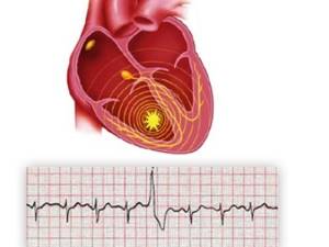 Экстрасистолия сердца: что это такое, причины экстрасистол, симптомы и методы лечения