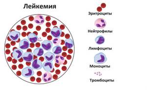 Анемия: лечение, симптомы, степени, причины и код МКБ 10