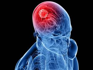 Смерть головного мозга: как развивается, причины, признаки, постановка диагноза