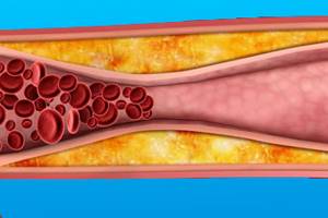 Облитерирующий атеросклероз сосудов нижних конечностей – симптомы и лечение