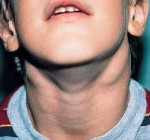 Почему воспаляются лимфоузлы на шее у ребенка с одной или с обеих сторон, слева или справа, как и чем их лечить