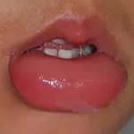 Опухла верхняя или нижняя губа: причины, что делать, лечение отека губ