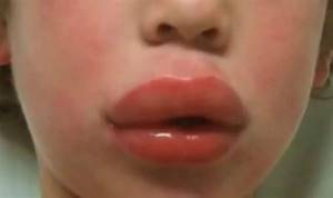 Опухла верхняя или нижняя губа: причины, что делать, лечение отека губ