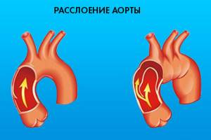 Аневризма аорты: симптомы, что это такое, расширение восходящего отдела, корня