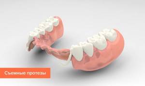 Зубные протезы при частичном отсутствии зубов: съемные и несъемные, виды, какие лучше, протезирование жевательных зубов