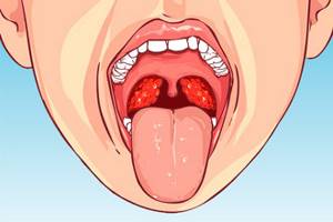 Гланды и миндалины в горле: расположение, функции, причины воспаления и методы лечения