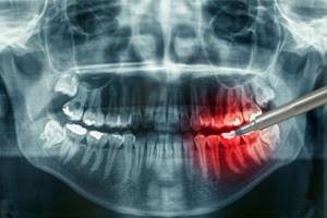 Остеомиелит нижней и верхней челюсти: симптомы, лечение хронического и травматического остеомиелита после удаления зуба