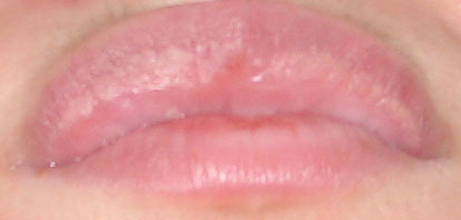 Белые точки и пятна на губах под кожей, в уголках: причины высыпаний и крапинок на губах