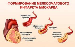 Микроинфаркт у женщины – симптомы и первые признаки