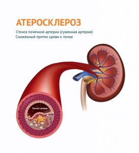 Гипертония (артериальная гипертензия): причины, симптомы и лечение