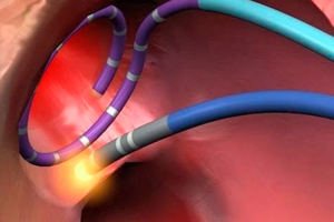 Радиочастотная абляция сердца (РЧА): показания к операции, осложнения, реабилитация