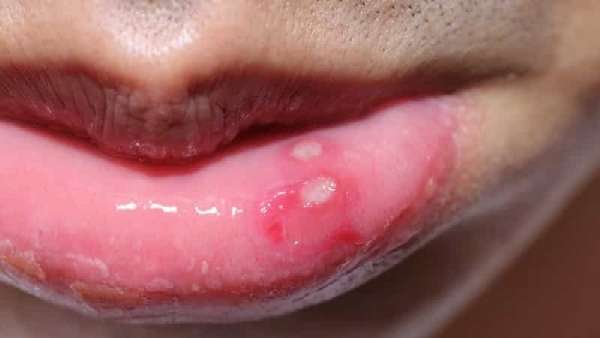 Почему на губах появляются белые пятна, как лечить