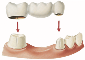 Съемные и несъемные зубные протезы при частичном отсутствии зубов, какой вид протезирования лучше