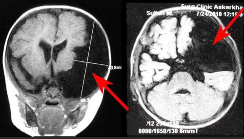 Лечение кисты головного мозга — методики, отзывы врачей и пациентов, последствия