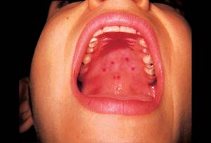 На корне языка ближе к горлу красные пупырышки и прыщи: что это, причины появления бугорков, лечение шишек